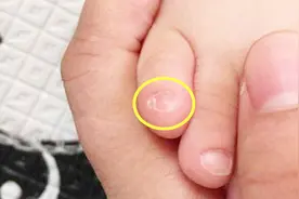 为什么很多中国人小脚趾甲是两瓣的？说出来你都不敢信视频封面