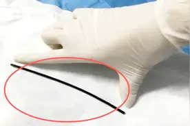 男子胃痛去医院，医生看到检查报告吓一跳，肚子里竟有12cm的金属