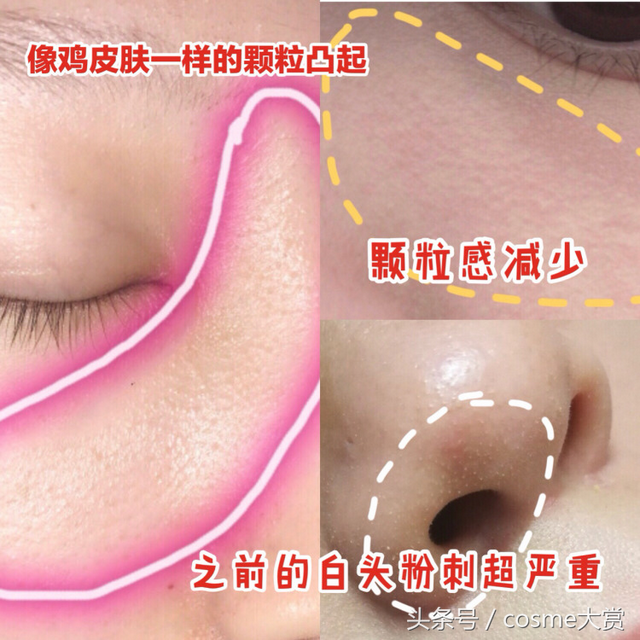 眼下面毛周角化