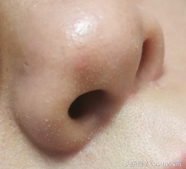 眼下面毛周角化