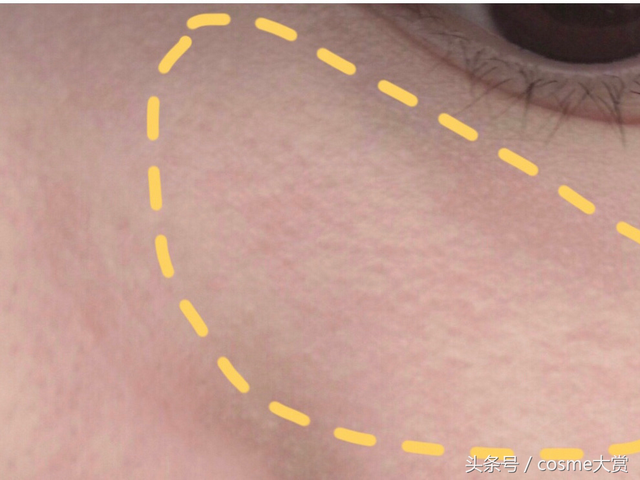 眼下面毛周角化