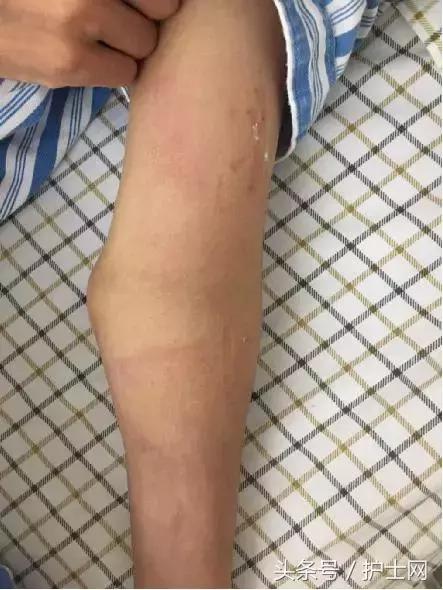 静脉炎的预防与处理：防“炎”于未然 消“炎”于当下