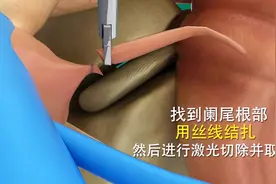 3D动画演示阑尾炎手术 原来要切的是这里，不是大肠，长见识了视频封面