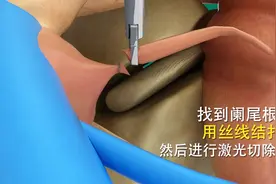 3D动画演示阑尾炎手术 原来要切的是这里，不是大肠，长见识了视频封面
