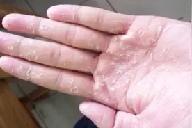 双手脱皮太难受了怎么办？只需一个土方法，轻松解决，省钱又实用视频封面