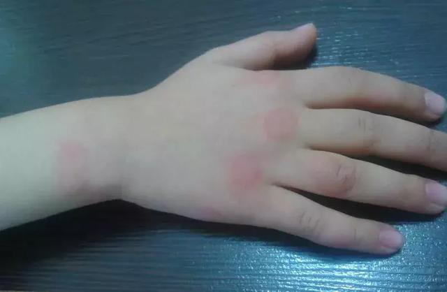 宝宝身上的红疹子不能掉以轻心!担心丘疹性荨麻疹找上门