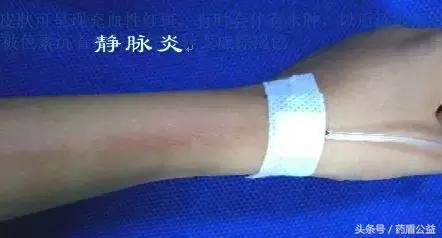 输液疼痛了解一下，这样就可以缓解