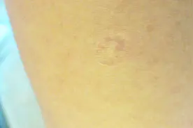 人们胳膊上的这个疤痕，你知道它是怎么来的吗？今天才知道真相