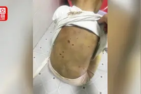 双眼发紫背部伤疤遍布 贵州4岁女童疑遭父亲虐待 警方介入视频封面