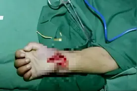 两岁女童右手肿胀、起脓泡、流脓四个多月，原因令人大吃一惊视频封面