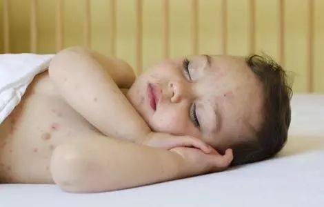 疥疮初期症状小红点