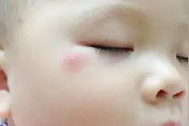 这些红疹不是蚊子包，妈妈们千万要注意视频封面