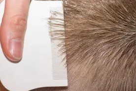 什么是虱子？虱子是怎么产生的？视频封面