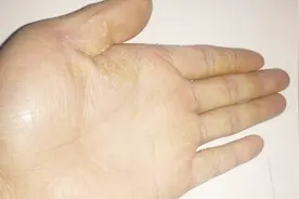 夏天手脚脱皮太难看？教你一个土方法，轻松解决手脚脱皮的难题