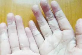 夏天双手脱皮太难看了，每天用这个搓洗一次……就能轻松去除死皮视频封面