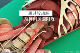 3D演示盆骨肿瘤手术过程，整块盆骨卸下，钢板螺钉上假肢，疼，痛视频封面