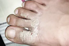一到这个季节脚就奇痒难忍？赶快用它泡泡脚，轻松去除脚气不复发视频封面