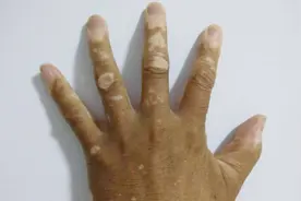 白癜风传染吗？皮肤科专家告诉你视频封面