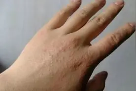 手脚起了水泡，又痒又难受，奶奶教我一个土方法，一擦就好