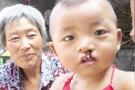 5岁宝宝爱咬自己嘴唇，最后嘴唇再也合不上了，医生：只能矫正了视频封面