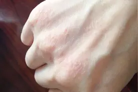 手上起半透明的水泡又痒又难受，教你一招土方法，不疼不痒效果好视频封面