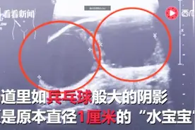 吓人！幼儿园中班10个孩子误吞“水宝宝” 遇水膨胀或致肠梗阻视频封面