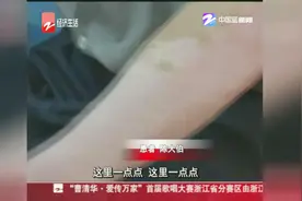我国白癜风患者超2600万，有效治疗不足两成视频封面