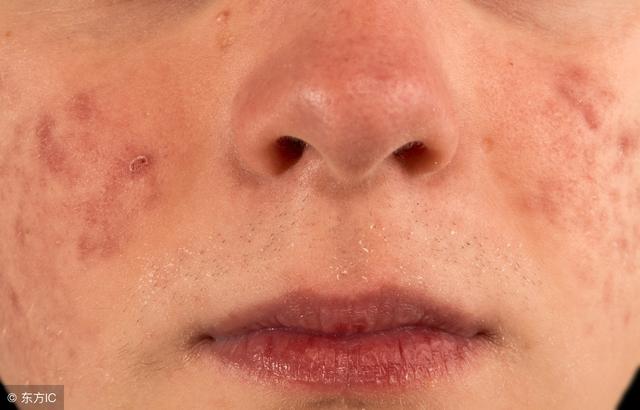 善治痈疽瘰疬,杨梅恶疮"小编选了这4篇文章,介绍土茯苓的应用.