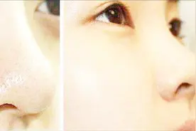 黑头你还在用不正确的方法挤吗？不要让黑头变黑洞！视频封面