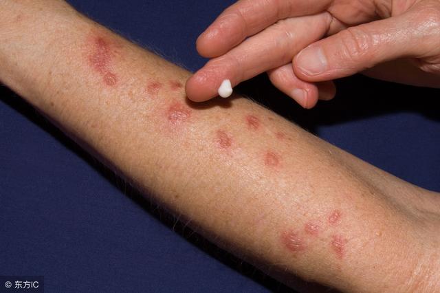 皮肤癌的早期症状和一些治疗方法(皮肤癌的早期症状和前兆) - 趣测网