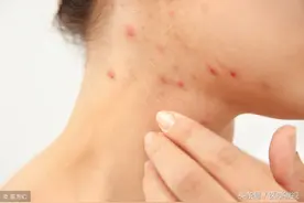 过敏性紫癜如何治疗？视频封面