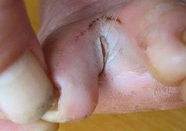 中药治疗手癣角化型湿疹