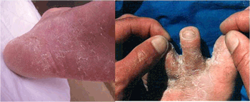 中药治疗手癣角化型湿疹