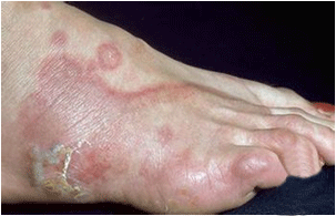 角化型足癣用什么药有效