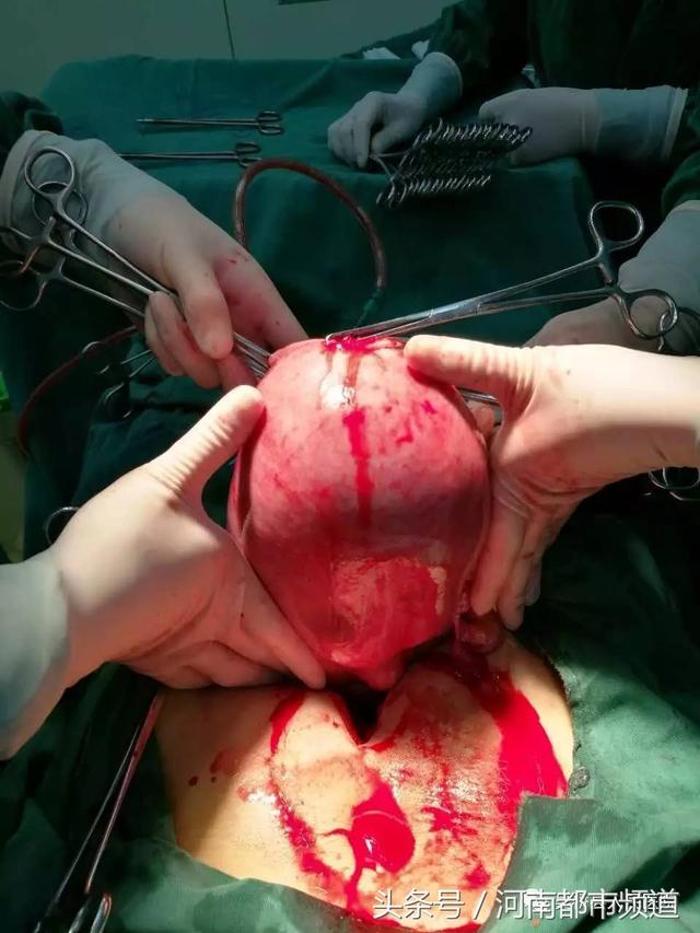 孕期吃燕窝畸形 孕期吃燕窝畸形怎么办