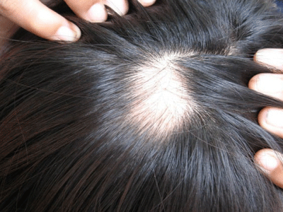 头发枯萎，一把把往下掉！中医师分享了3个防脱发方子，要牢记！