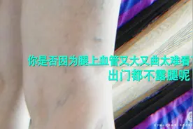 静脉曲张，大部分人没见过这个吧？3D演示视频封面