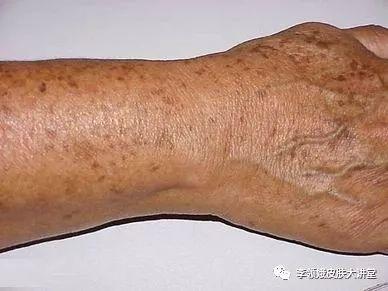 伤口组织角化增生图片