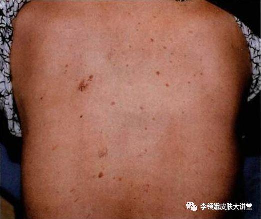毛囊角化和脂溢性角化区别