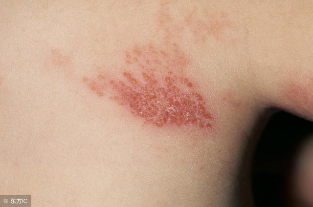 带状疱疹症状及后遗症的治疗