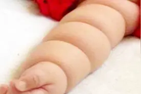 孩子出生手臂像莲藕那样一节一节的话，马上送医，不要犹豫！