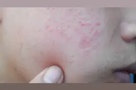 严重痤疮多久能好？视频封面