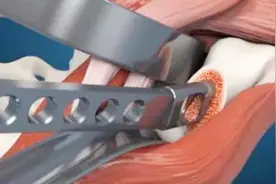 3D揭秘股骨头置换全过程 看完更要保护好自己视频封面