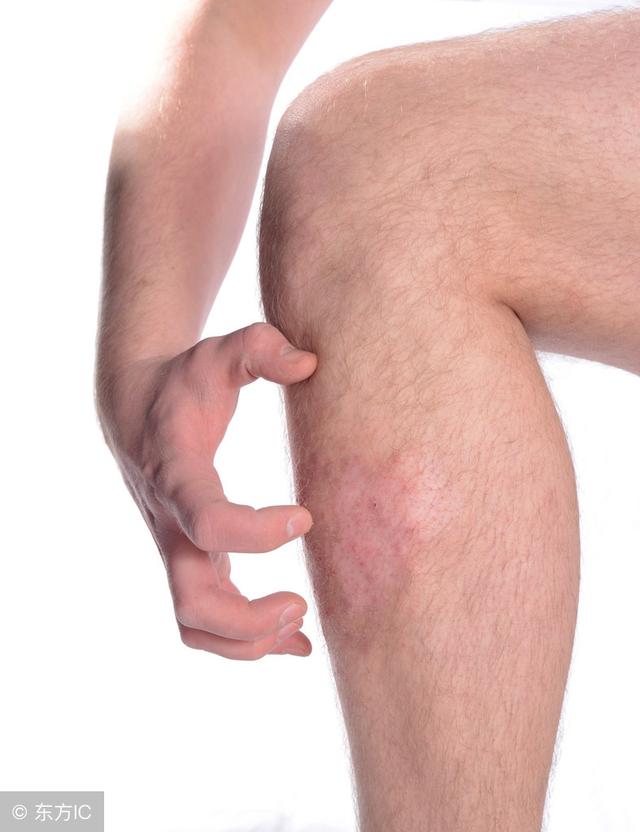 血管角化瘤与雌激素