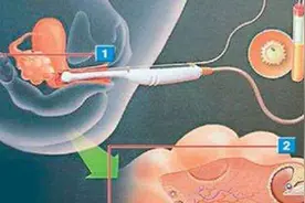 试管婴儿是怎样出生的？揭密试管婴儿全过程，生个孩子太难了！视频封面
