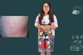 背部经常会发痒？或许是这3个原因，不妨了解一下！视频封面