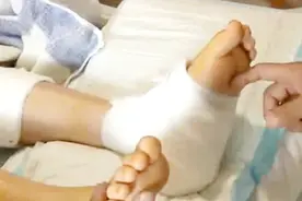 女孩扁平足一运动就脚痛，医生给她手术，加了个“螺钉”就治好了视频封面