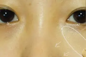 黑眼圈别大意，可能是这3种身体疾病的前兆！对照看看你有没有视频封面