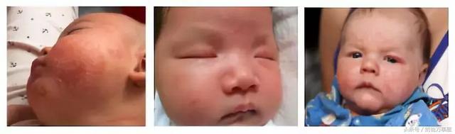 小孩皮肤长鸡皮疙瘩白点 小孩皮肤长鸡皮疙瘩白点