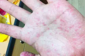 手上起了小水泡不用买药膏，用家里都有的它来涂抹，几天就好视频封面